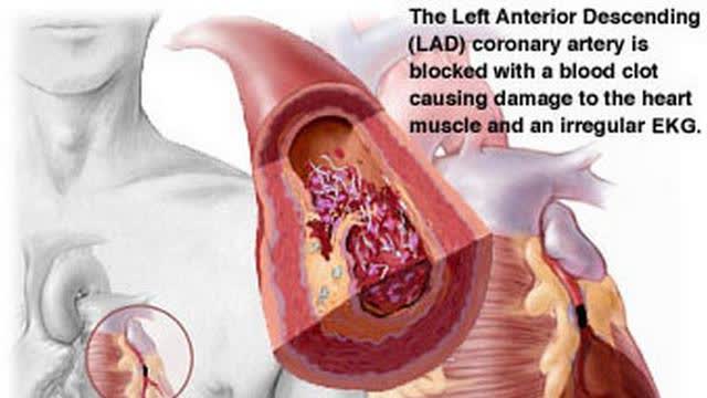 BLOOD CLOT!ðŸ’‰â¤ï¸â€ðŸ©¹