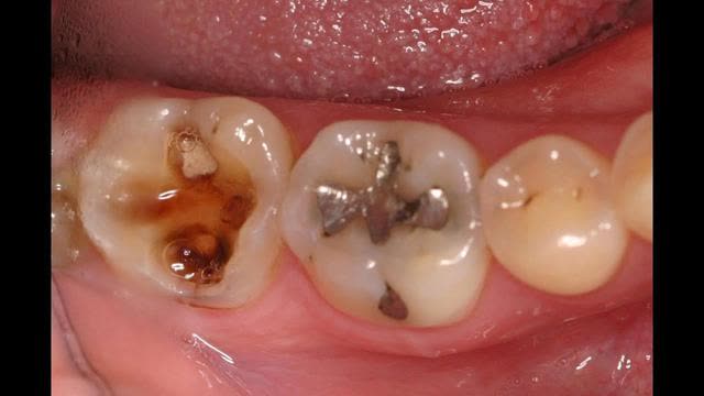 No Need To Visit The Dentist, Treat Tooth Decay And Cavity At Home With This Powerful Ingredients