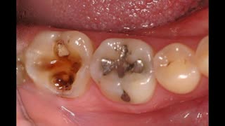 No Need To Visit The Dentist, Treat Tooth Decay And Cavity At Home With This Powerful Ingredients