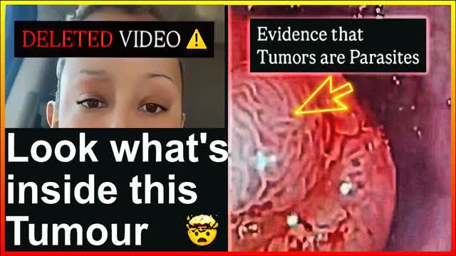 Hey, you won’t believe what’s hiding out in this tumor: it turns out tumors can hold parasites!