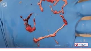 Richard Hirschman Embalmer Funeral Director Shows Massive Unique Blood Clots on Dr Jane Ruby Show