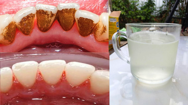 How to remove plaque from teeth at home naturally In 3 Minutes with baking soda