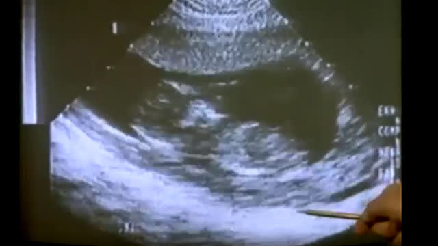 ultrasound of an abortion. very eye opening. show to any abortion activist