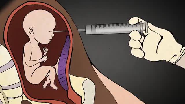 Dr. Anthony Levatino - 3rd Trimester Abortion via LETHAL Injection AUG.22.2018