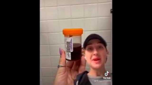 BLACK URINE and other problems After 2 Pfizer COVID SHOTS