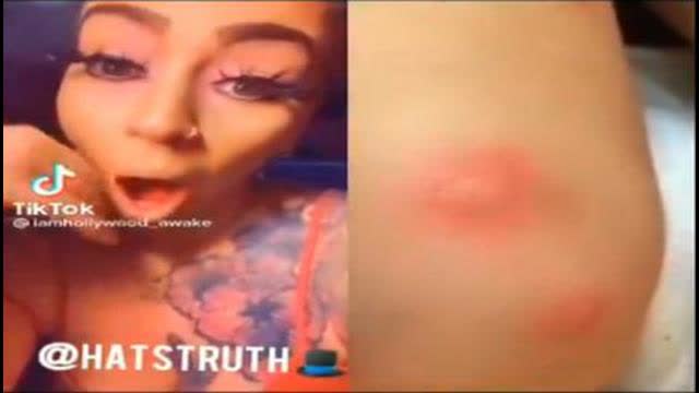 Bill Gates weaponized GMO mosquito bites woman in Florida and leaves its mark