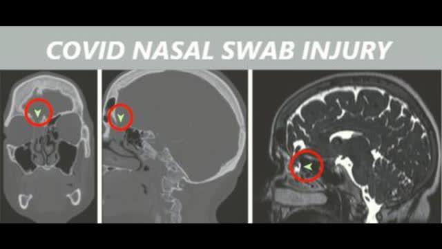 No more swabbing the nose! Recall on cv19test - it may cause serious injury or even death